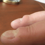 гипертрофированная ониходистрофия ногтей
