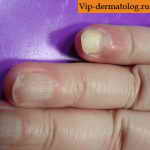 онихолизис ногтей