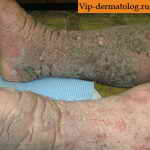 Папилломатоз карциноидный ног