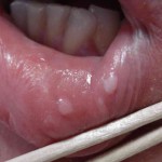 папилломатоз полости рта