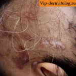 узловатая почесуха на волосистой части головы фото