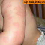 аллергическая крапивница у детей лечение