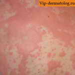 аллергический дерматит крапивница у ребенка