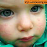 аллергическая крапивница у ребенка на лице