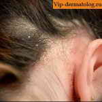 микозы волосистой части головы