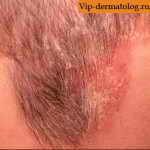 микоз кожи головы первая стадия лечение