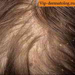 микоз волосистой части головы до лечения