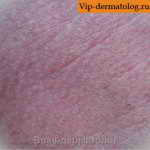 Эритромеланоз кожи фото