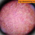 эритромеланозная межфолликулярная сыпь фото