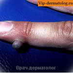 Фиброкератома на пальцах рук фото