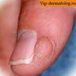 Фиброкератома на коже у ногтя фото