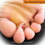Фиброкератома на пальцых ног фото