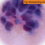 фибропапиллома кожи фото