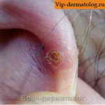 Хондродерматит узелковый на завитке ушной раковины фото