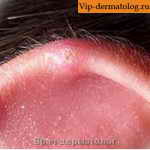 Хондродерматит узелковый ушной раковины фото