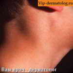 псевдолимфома кожи фото