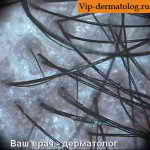 псевдопелада волос фото