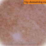 Пурпура тромбоцитопатическая на коже фото