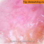 плоскоклеточный рак шейки матки фото