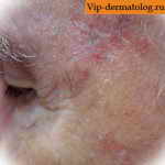 плоскоклеточный рак кожи лица фото