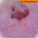 плоскоклеточный язвенный рак фото