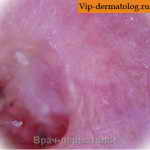 плоскоклеточный язвенный рак кожи фото