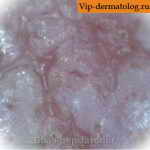 заболевание кожный рог фото
