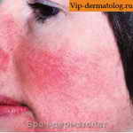 заболевание кожи лица розацеа фото