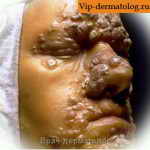 симптомы третичного сифилиса фото
