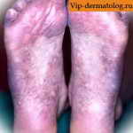 Синдром Ротмунда-Томсона фото на ногах