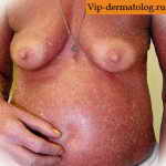 Синдром Сезари на груди фото