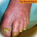 Синдром Сезари на ноге фото