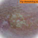 бляшечная склеродермия кожи фото