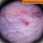 кортикостероидные стрии кожи у человека фото