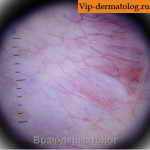 кортикостероидные стрии кожи фото