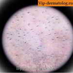 буллезная токсикодермия под микроскопом фото
