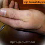 Токсикодермия меланодермическая на руке фото