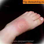 укусы насекомых у детей фото на ноге