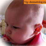 жировик у новорожденных на голове фото