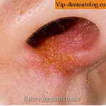 стрептодермия в носу у ребенка фото