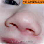 стрептодермия в носу лечение фото