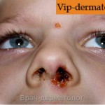 Стрептодермия носа у ребенка