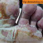 дисгидротическая экзема пальцев ног фото