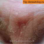 себорейный дерматит кожи фото
