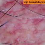Фолликулярный эритромеланоз шеи фото