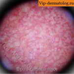 Эритромеланоз фолликулярный под микроскопом фото