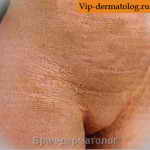 врожденная буллезная ихтиозиформная эритродермия фото