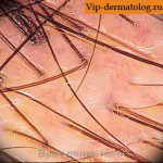 жирная себорея кожи головы лечение