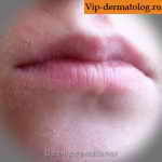 шелушение кожи вокруг губ