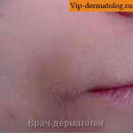 шелушение кожи вокруг рта